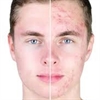 Acne Treatment