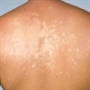 Acne Treatment
